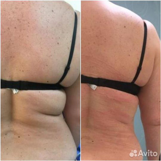 Криолиполиз, кавитация, прессотерапия, LPG, емс