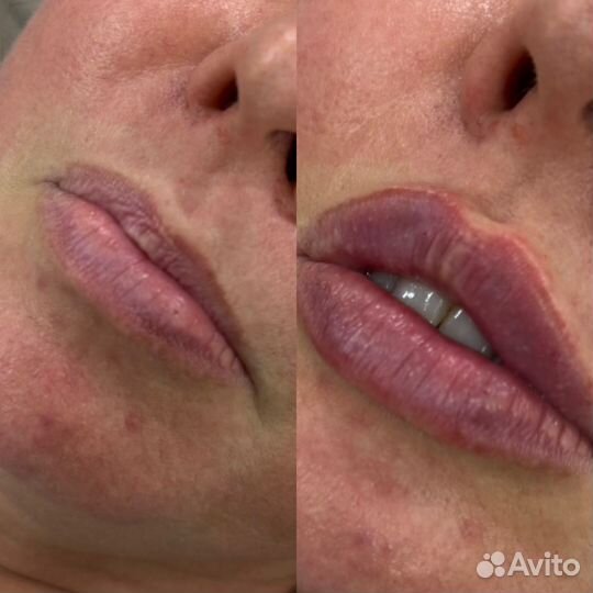 Увеличение губ