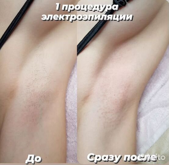 Электроэпиляция