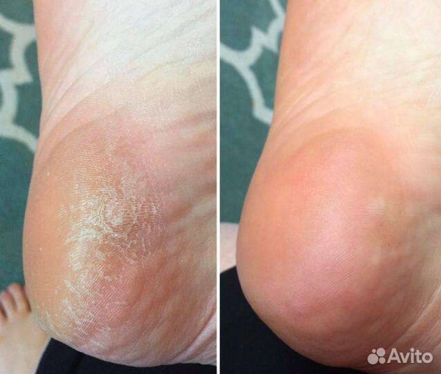 Педикюр / мозоли / вросшие ногти / трешины