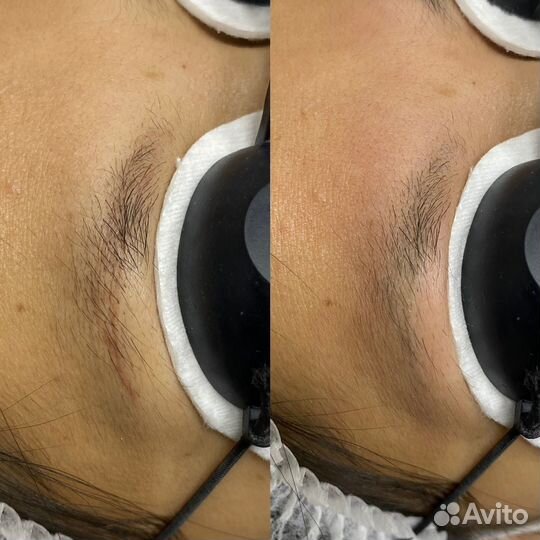 Удаление татуажа и тату лазером