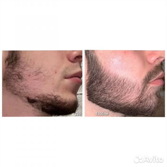 Лечения выпадения волос у мужчин