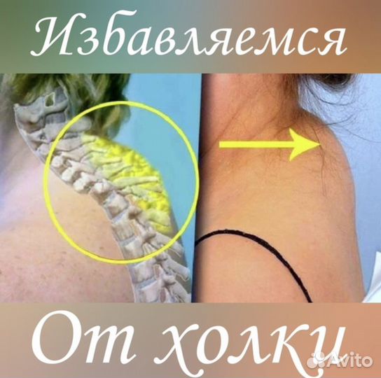 Липосакция аппаратная