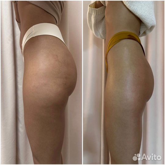 Антицеллюлитный Массаж