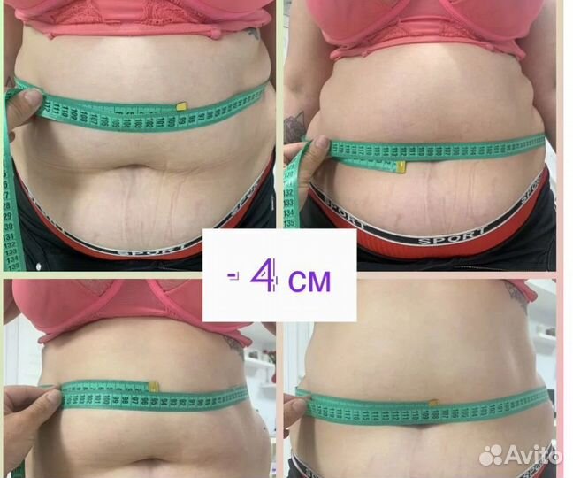 Новая технология похудения Криолиполиз