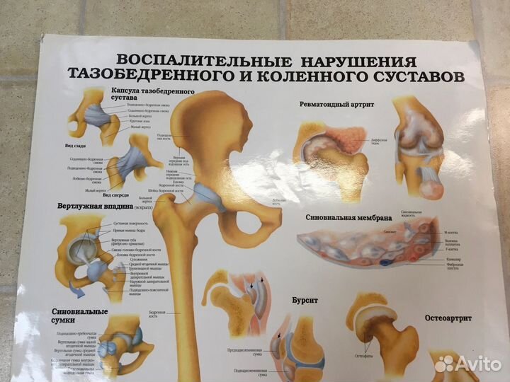 Плакат медицинский артрит 2 стороны