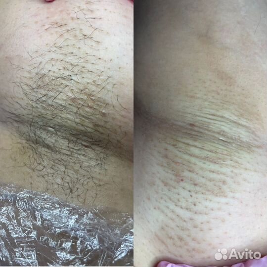 Электроэпиляция