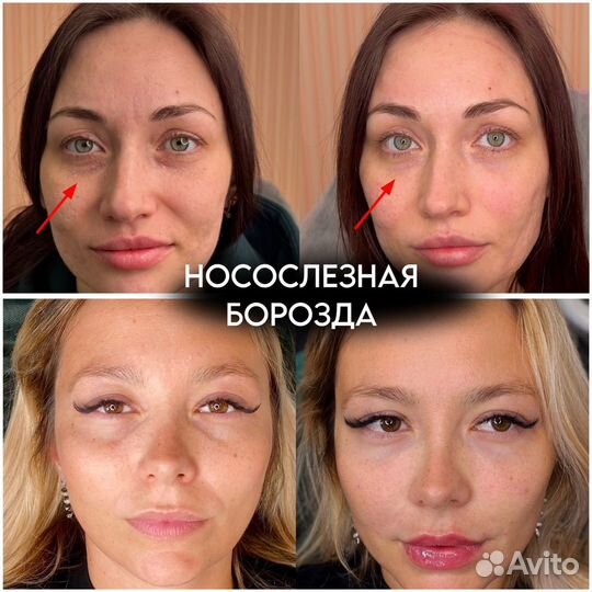 Увеличение губ, углы джоли, full face, модели