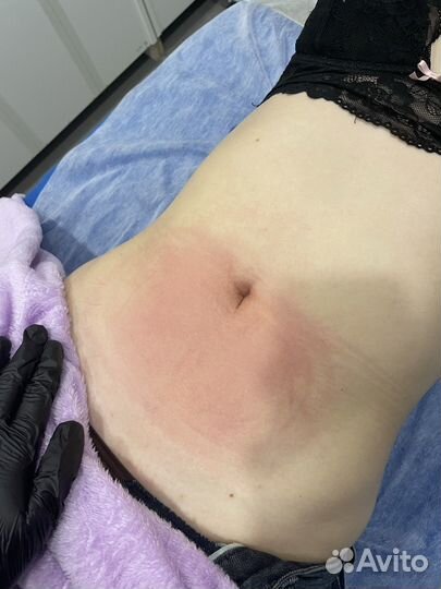 Аппарат для криолиполиза