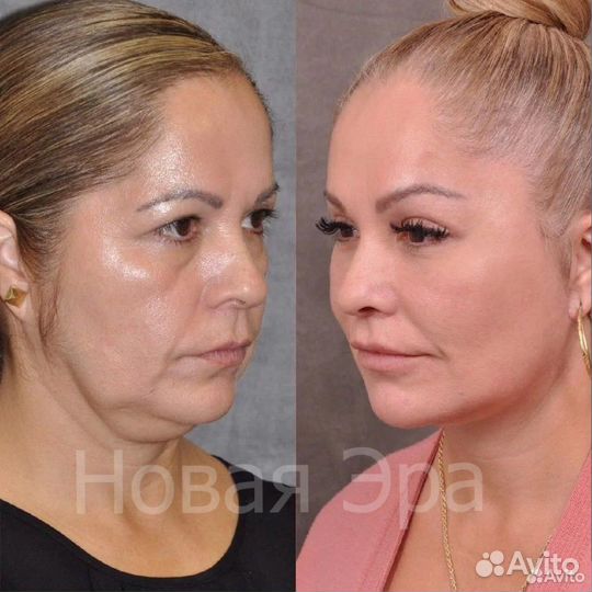 Ультра омоложение /подтяжка лица/ Минус 15 лет за