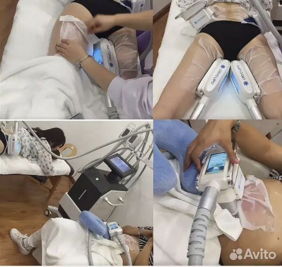 Криолиполиз,кавитация,карбоновый пилинг,эндо360