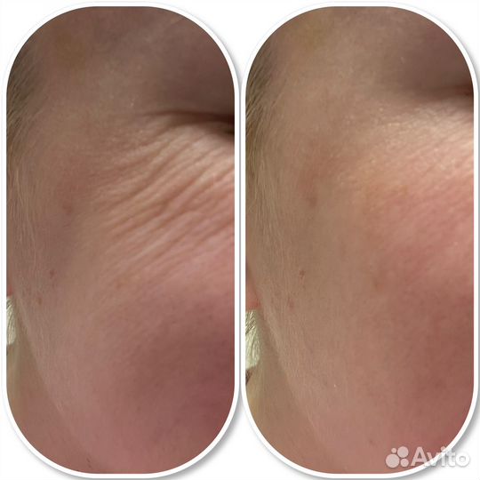 Чистки лица