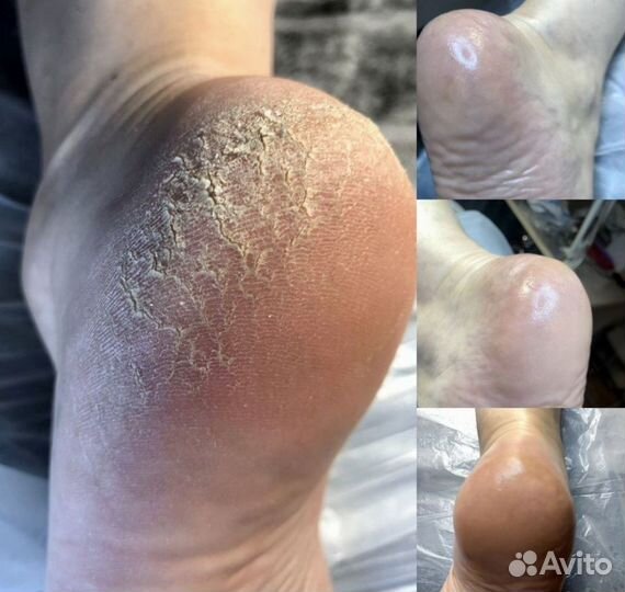 Лечебный педикюр/ подолог с мед.образованием