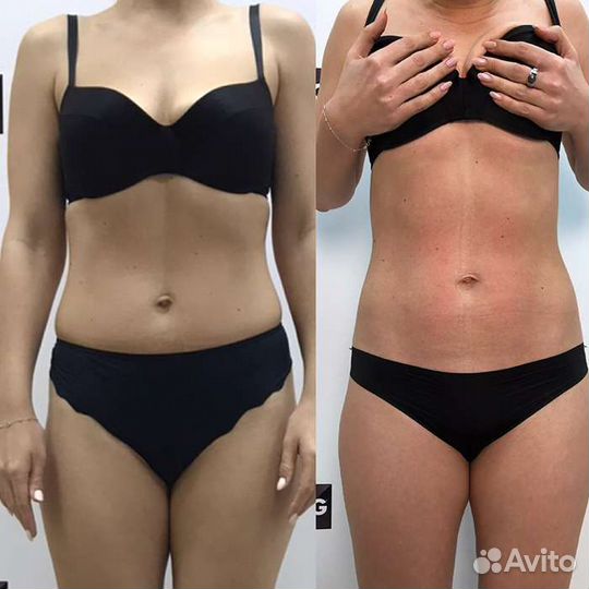 Криолиполиз, LPG, коррекция фигуры Светлогорск