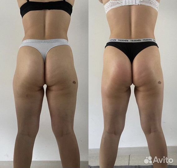 Антицеллюлитный массаж