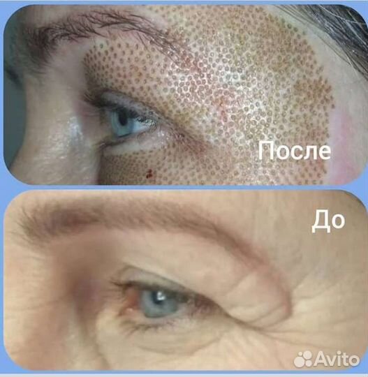 Блефаропластика