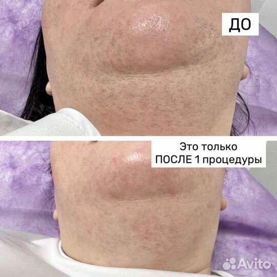 Лазерная эпиляция Клин
