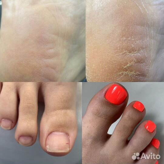 Педикюр. Лечебный педикюр