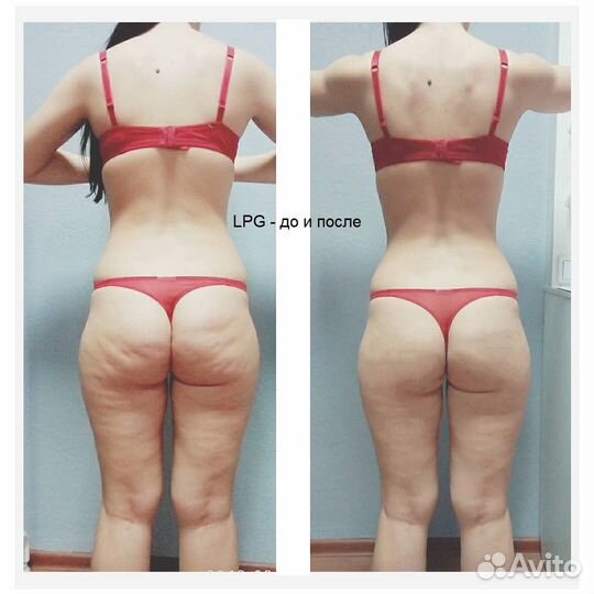 LPG, массаж, микротоки, LPG обучение+сертификат