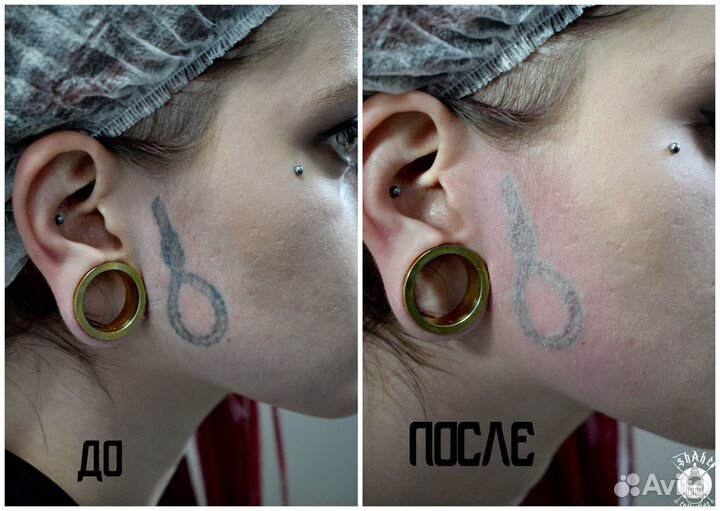 Лазерное удаление тату и ПМ, карбоновый пилинг