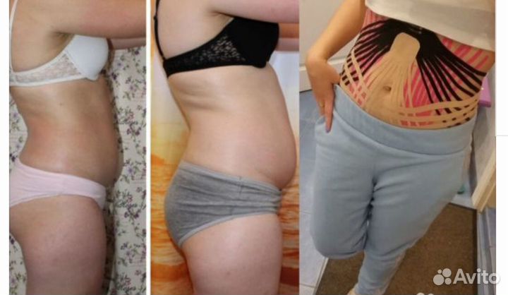 Коррекция фигуры,эстетическое кинезио тейпирование