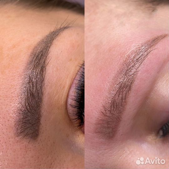 Удаление татуажа