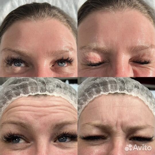 Биоревитализация