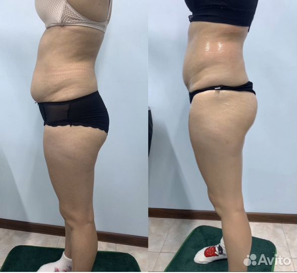 Вакуумный массаж,RF-лифтинг,кавитация,биофотон