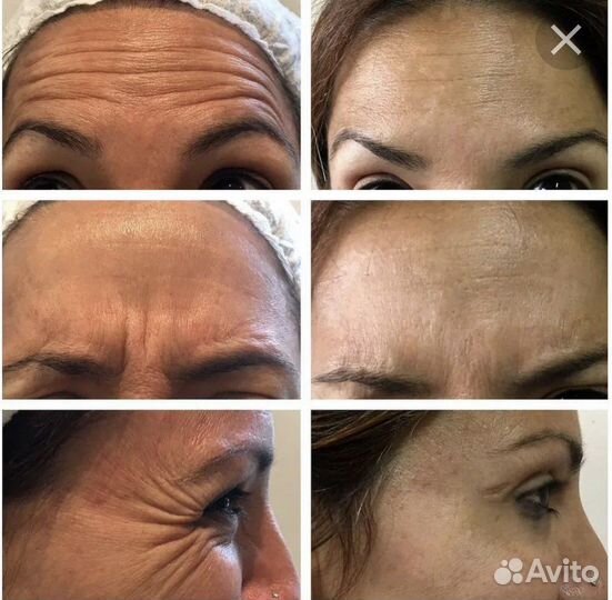 Ботокс для лица