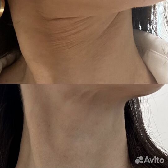 Микроигольчатый RF лифтинг косметолог омоложение