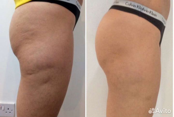 Антицеллюлитный массаж ручной,релакс,массаж лица