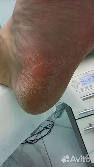 Педикюр подолог