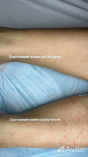 Электроэпиляция