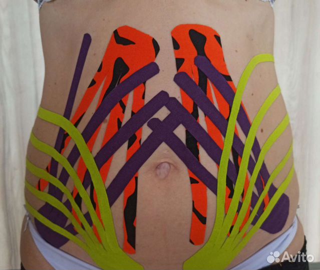 Эстетическое тейпирование тела