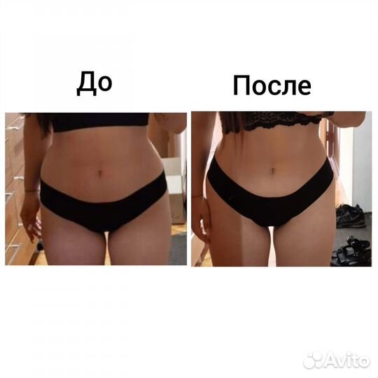 Криолиполиз / Коррекция фигуры