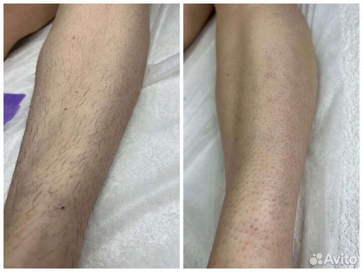 Восковая депиляция