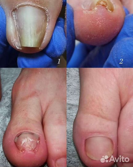 Педикюр подолог