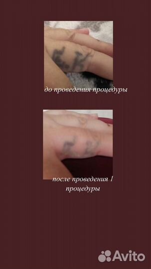 Удаление перманентного макияжа и тату