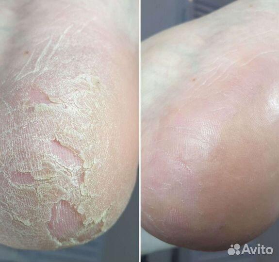 Лечебный педикюр/ подолог с мед.образованием