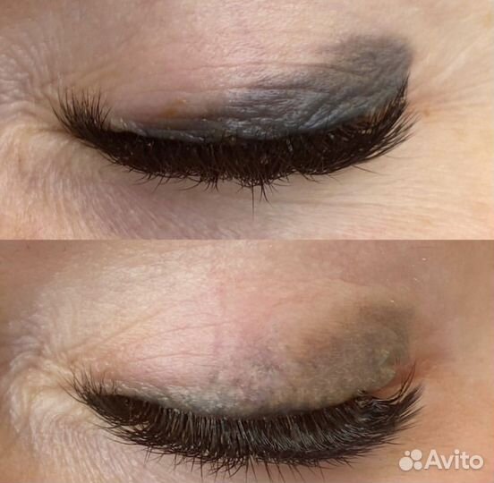 Удаление татуажа лазером