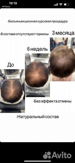 Мезотерапия головы/Восстановление роста волос