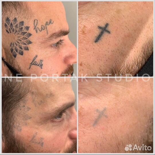 Удаление татуировок