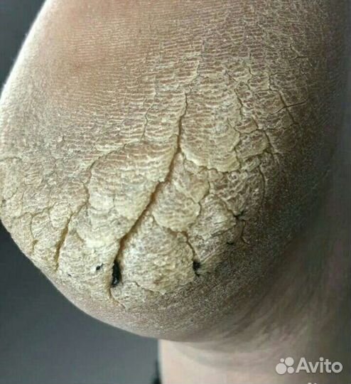 Грибок ногтей бородавки удаление