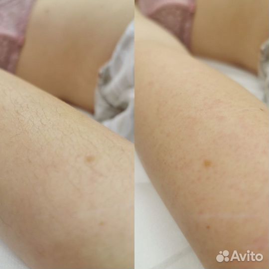 Депиляция - сахар/ воск. кмр