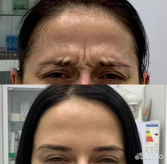 Ботокс для лица