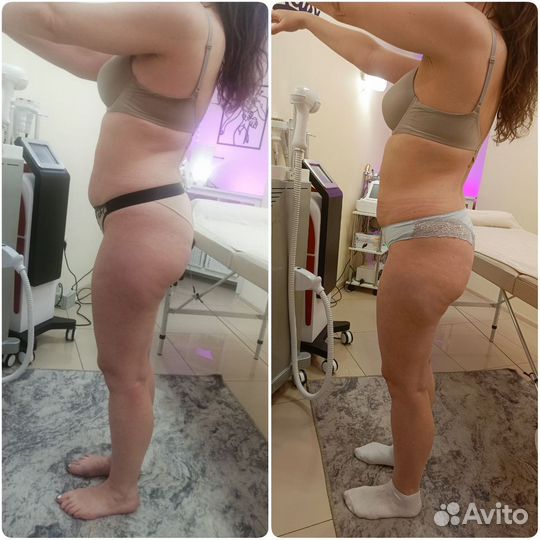 Кавитация, LPG, вакуумный