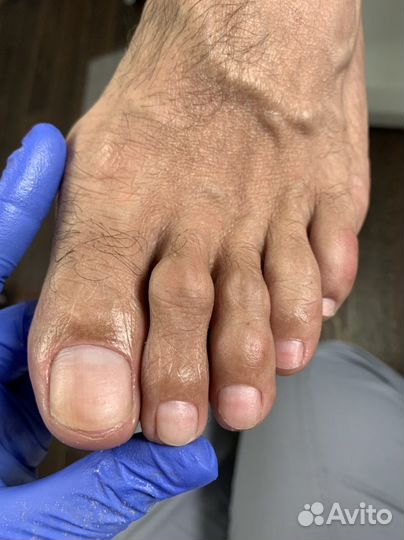 Медицинский педикюр. Подолог