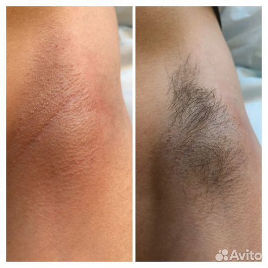 Депиляция для мужчин