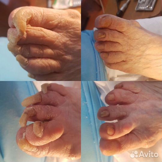 Аппаратный педикюр