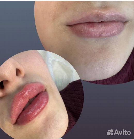 Контурная пластика губ